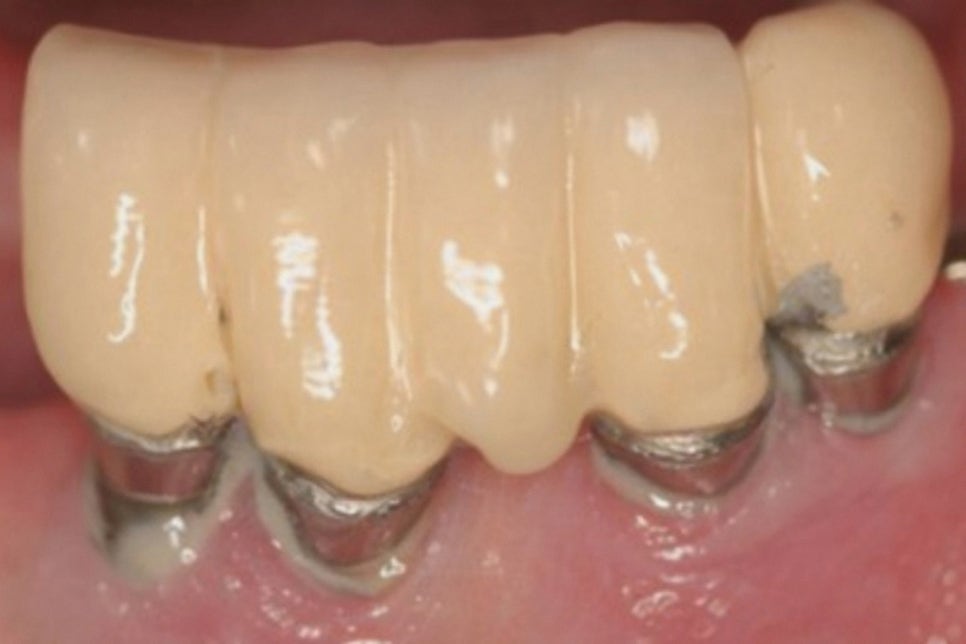 임플란트 관리가 더욱 중요한 이유! 생활 습관으로 달라질 수 있는 보철의 수명 : 당산 치과 관련 이미지 3