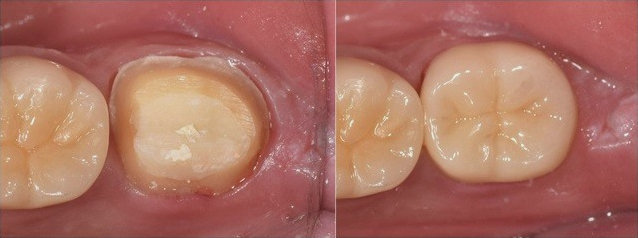 Why a Tooth Crown Is Needed After Root Canal Treatment at a Dental Clinic Near Yeongdeungpo-gu Office Station image 8