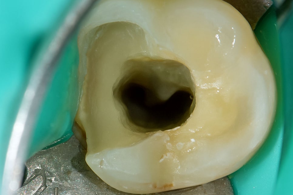 당산역 치과 : 보이지 않는 신경을 찾는 방법, 치아 치료 시 사용하는 미세현미경 관련 이미지 4
