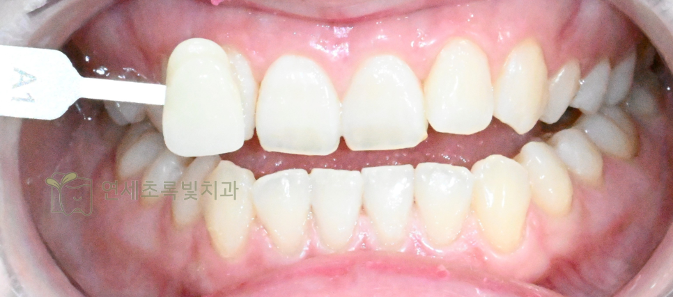 당산동 치과 원데이 화이트닝, 미백 치약보다 효능 확실한 이유는?! 관련 이미지 4