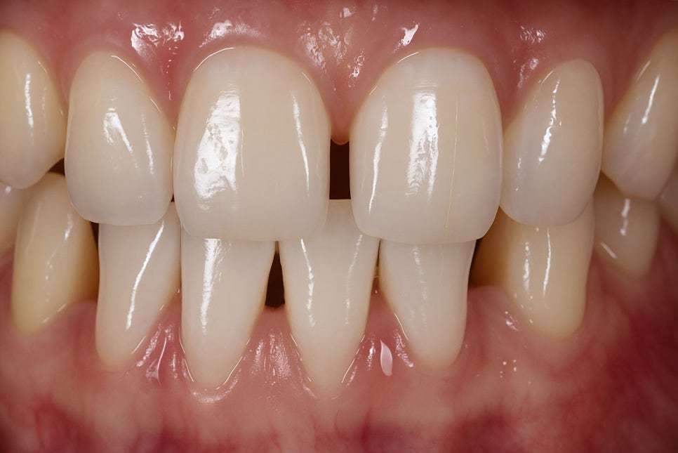 라미네이트, 보존과 전문의에게 받아야 되는 이유를 당산역 치과 에서 알려드립니다. 관련 이미지 2