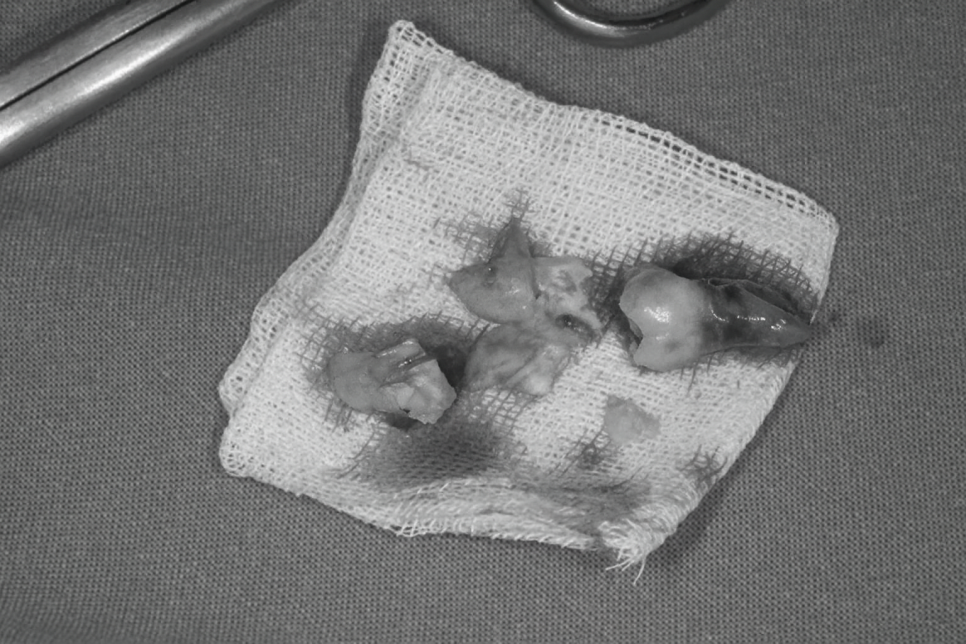 영등포동 치과 사랑니 발치 후 식사, 언제부터 가능할까? ft. 하치조 신경관 관련 이미지 4