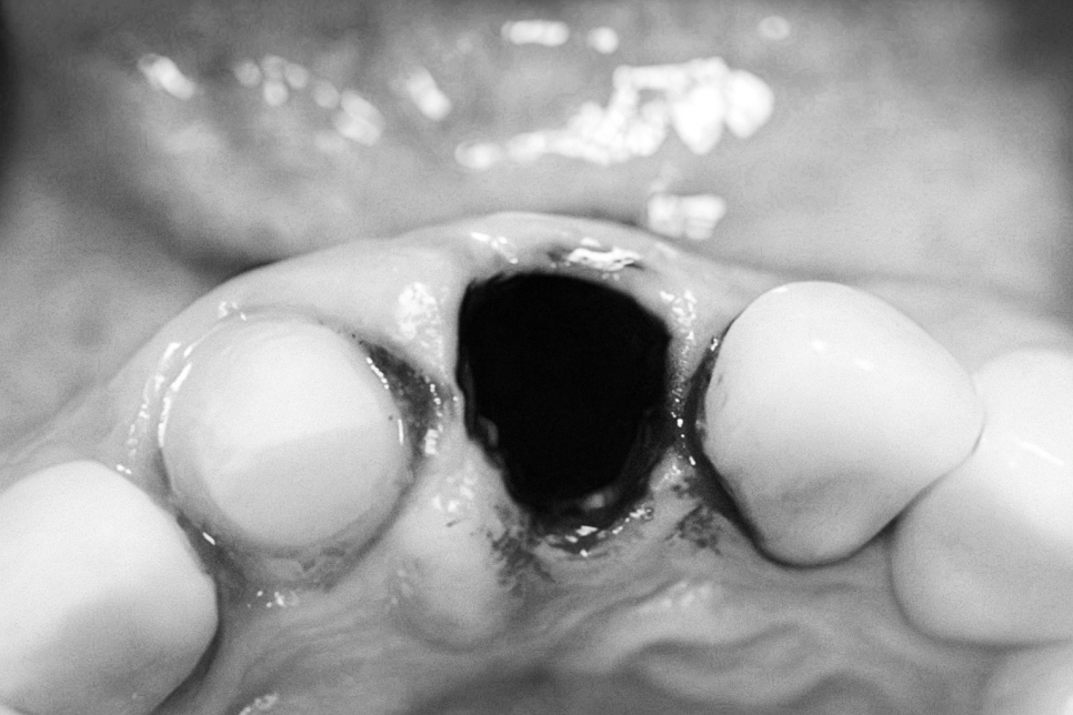 영등포구청역 치과 임플란트 수술 왜 기다렸다 하나요? ft. 발치와 보존술 관련 이미지 2