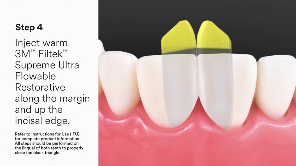 Dangsan-dong Dental Clinic: Were You Disappointed with Your Front Tooth Composite Result? Anterior Tooth Restoration Using the BioClear Matrix image 6