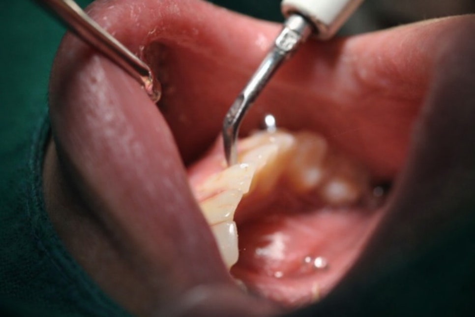 하얀 치아를 가지고 싶다면? 당산역 미백 치과 와 알아보는 시술 과정 관련 이미지 5