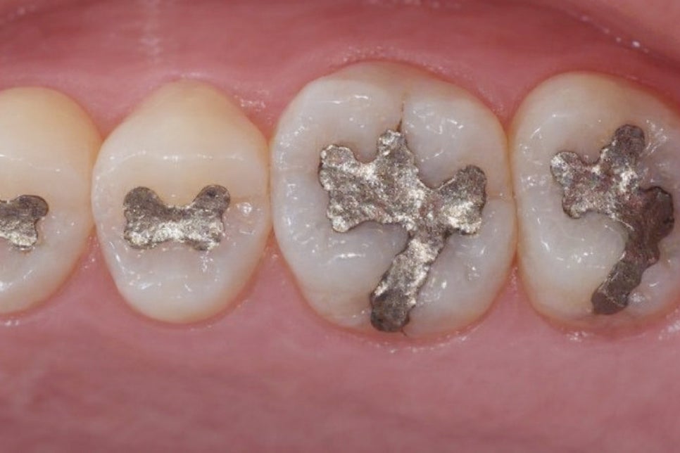 치아 크랙 방치하면 안 되는 이유 파절 증상부터 원인까지 당산 보존치과 에서 알려드립니다! 관련 이미지 3