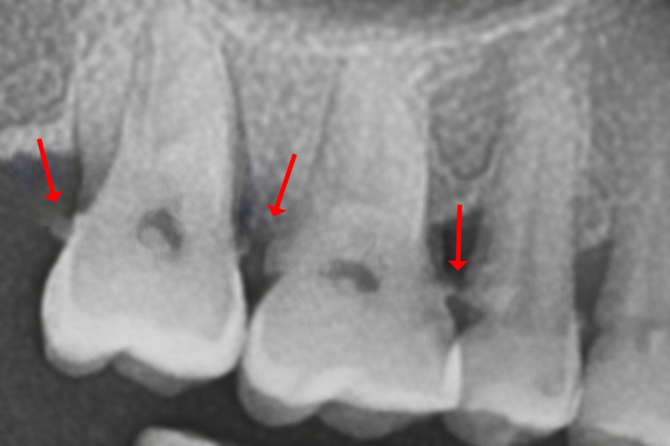 당산 치과 치은연하치석이란? 주기적으로 스케일링 받아야 되는 이유! 관련 이미지 5