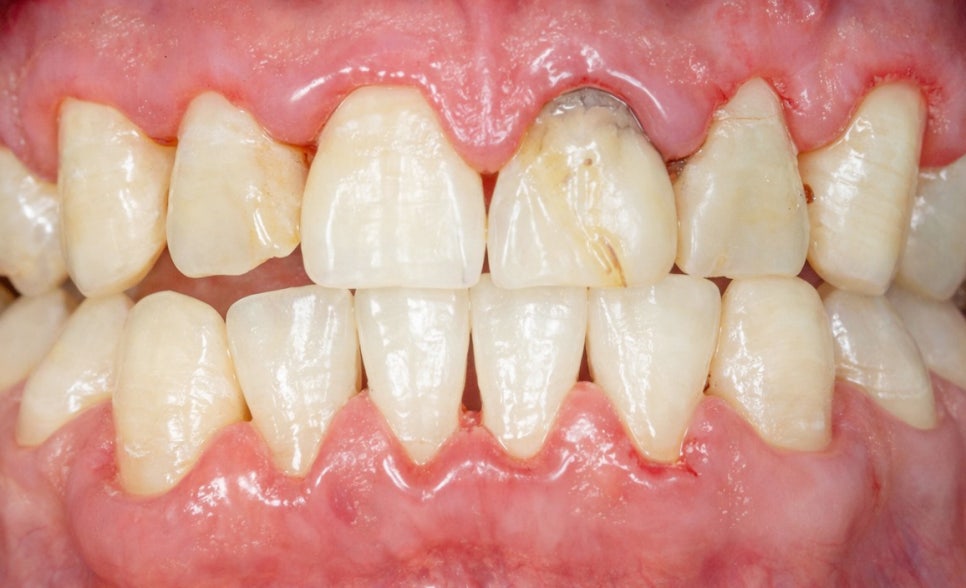 선유도 치과 다발성 우식증으로 이어질 수 있는 구강 건조증 어떻게 예방할 수 있을까? 관련 이미지 5