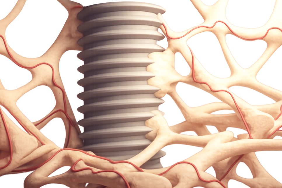선유도역 치과 임플란트 성공을 방해하는 요소 ft. 하중부하, 픽스처 표면 처리 및 흡연 관련 이미지 1