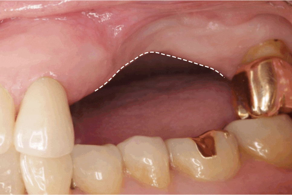 영등포구청역 치과 치아 상실 시 발생할 수 있는 구강 내 문제점은 무엇이 있을까? 관련 이미지 4