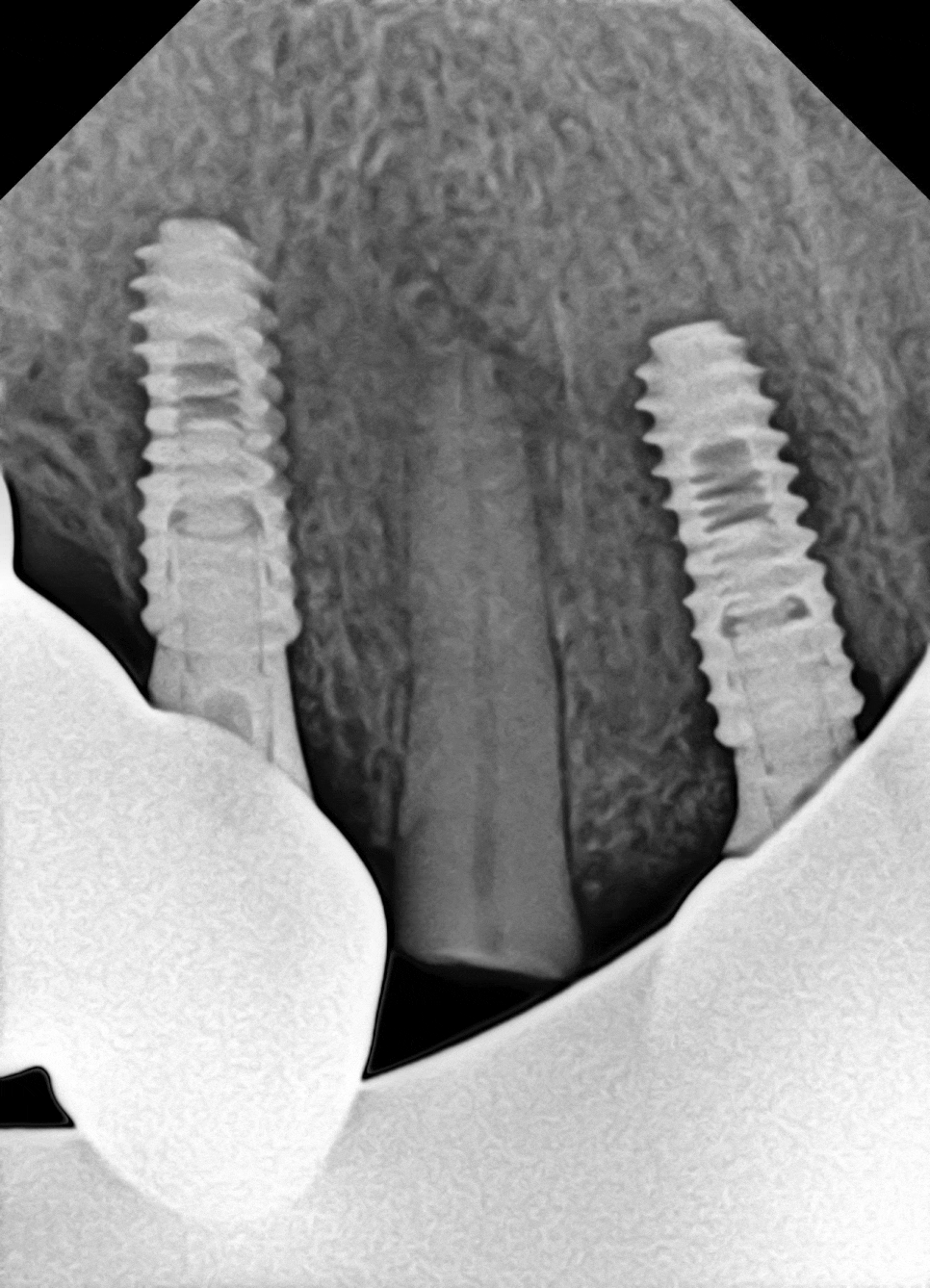 당산동 치과 앞니 파절 : 치관확장술이 필요할 수 있습니다. 관련 이미지 5